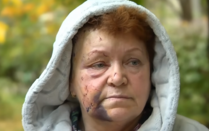 Александра, пострадавшая от взрыва в Киеве.