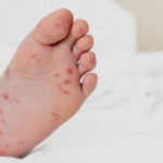 Спалах вірусу Коксакі на Київщині: захворіли 13 дітей