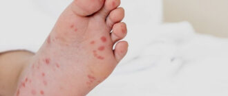 Спалах вірусу Коксакі на Київщині: захворіли 13 дітей