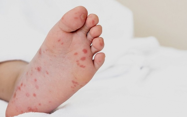 Спалах вірусу Коксакі на Київщині: захворіли 13 дітей Спалах вірусу Коксакі на Київщині: захворіли 13 дітей