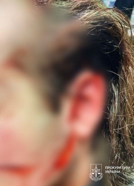 
 У Києві чоловік з ножем накинувся на підлітка біля метро: порізав обличчя (чутливий контент)
 